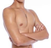 gynecomastia
