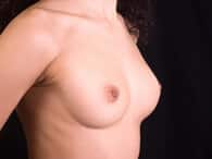 Breast Reduction