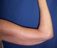 Arm-Lift