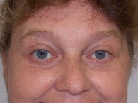 Face Lift