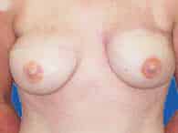 DIEP-flap