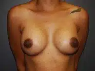 A post-surgery of a patient's breasts in a central view of her body