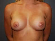 Breast Implants Patient 9 After Front
