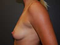 Breast Implants Patient 9 Before Left