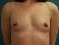 A patient woman's front view of her breasts before the surgery