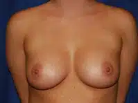 The center view of a patient woman showing her breasts post-surgery.