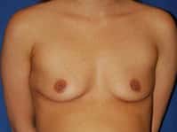 patient 12 breast prefront