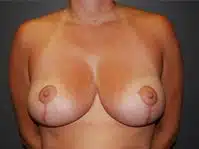 A patient's post-surgery of her breasts at Perimeter Plastic Surgery