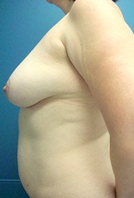 A left-sided view of a patient woman before DIEP breast reconstruction surgery.