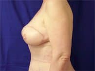 A left-view shows an after-surgery of a patient woman.