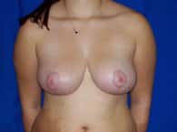 Post-surgery results for a breast surgery patient
