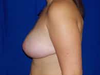 A patient in left view of her breast, arm and upper tummy after the successful surgery