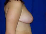 A patient on the right side of her breast, tummy, and arm after the surgery