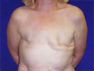 A woman's front angle before getting breast implants surgery.