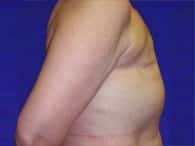 A side view of the right side of a patient's torso shows only the arm and chest before the surgery.