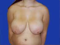 A front angle of a patient woman's breasts and abdomen before breast reduction surgery.