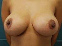 bfaf jv12132013 breast postfront