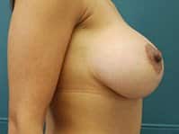 A woman's right side is showing her breast and arm after the surgery.