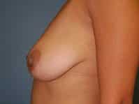bfaf jv12132013 breast preleft
