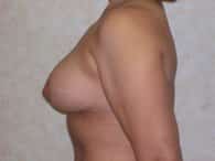 breast after small3