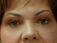 A front view of a patient woman showing her eyelids after eyelift surgery.