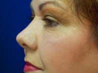 A close-up of a patient's left face showing her eyelid after the eyelift surgery.