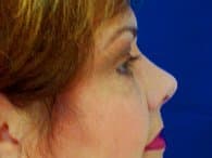 The patient's right-angle of her face showing the successful results of her eyelift surgery.