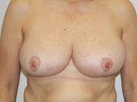 A front view of a patient woman's breasts and stomach post-operation
