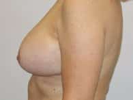A patient woman on the left view of her breast after the surgery