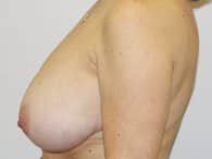 A patient woman with left breast and arm showing before surgery