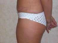 lipo after small3