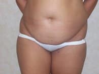 lipo before small1