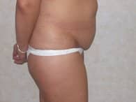 lipo before small2