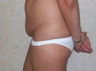 lipo before small3