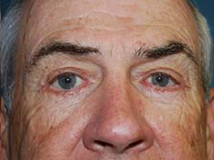 A patient's man close-up face after a facelift procedure at Perimeter Plastic Surgery
