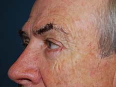 A patient's upper left face after the eye lift surgery.