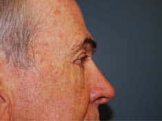 A close-up angle of a male patient's right side of face after he underwent eye lift surgery.