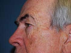 A male patient showing the left side of his face before facelift procedure