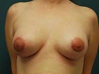 A patient's front angle of her breast after the mastopexy surgery.