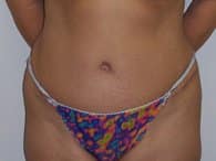 A patient in a front view of her tummy after the tummy tuck surgery