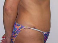 A patient in the right view of her abdomen after surgery.