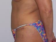 The patient was wearing a colorful undergarment on her left side after the surgery.