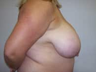 A pre-surgery view of a patient's breast and arm
