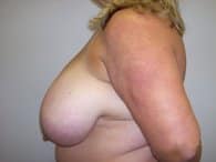 One of the patients in the PPS is shown in her left angle, displaying her breast and one arm at the back before surgery.
