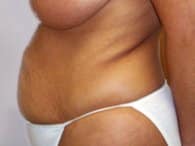 The patient's abdomen, wearing white underwear and visible in a left-view.