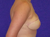 A patient's right breast and arm after the surgery.
