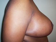 A right-sided view of a female patient, showing only her right arm and breast after surgery.