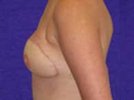 The patient's left breast and arm are shown after the surgery.
