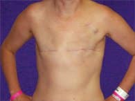 A patient's front chest and abdomen before the surgery.