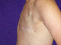 A patient's view of the left chest and arm after the breast reconstruction
